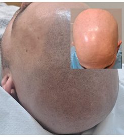 Akorda Micropigmentación