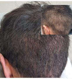 Akorda Micropigmentación