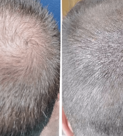 Akorda Micropigmentación